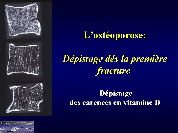 L’ostéoporose: Dépistage dés la première fracture Dépistage des carences en vitamine D 