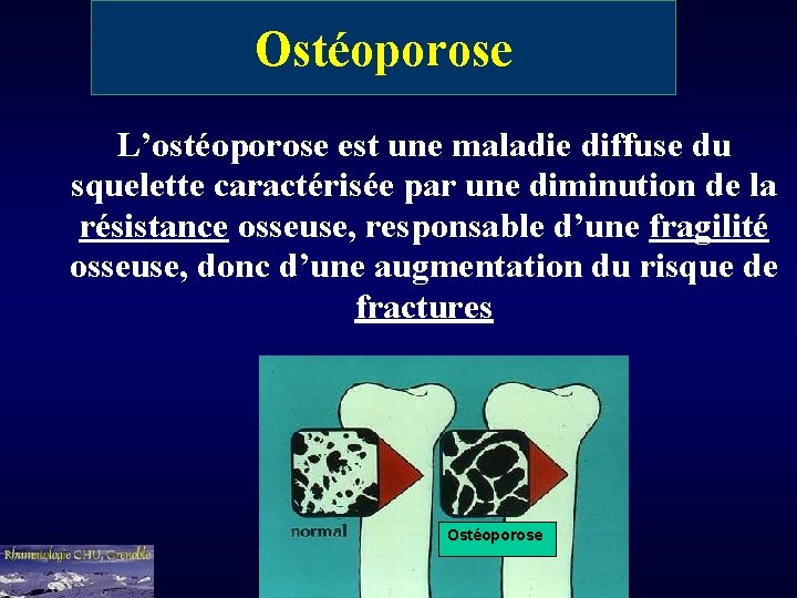 Ostéoporose L’ostéoporose est une maladie diffuse du squelette caractérisée par une diminution de la