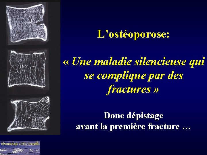 L’ostéoporose: « Une maladie silencieuse qui se complique par des fractures » Donc dépistage