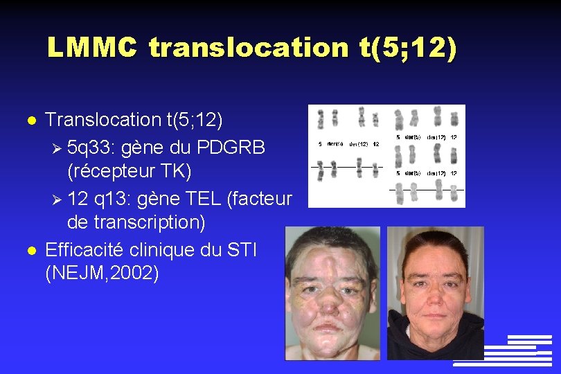 LMMC translocation t(5; 12) l l Translocation t(5; 12) Ø 5 q 33: gène LMMC translocation t(5; 12) l l Translocation t(5; 12) Ø 5 q 33: gène