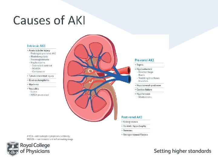 Causes of AKI 