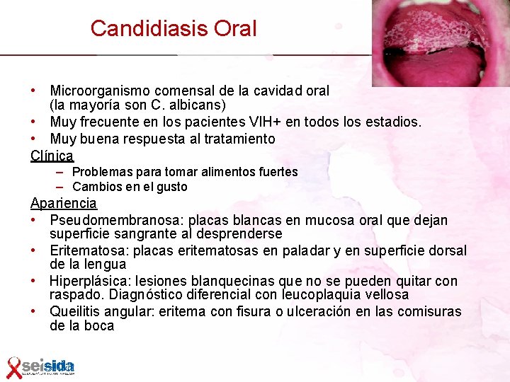 Candidiasis Oral • Microorganismo comensal de la cavidad oral (la mayoría son C. albicans)