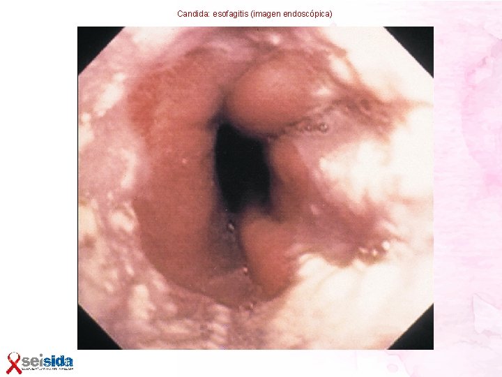 Candida: esofagitis (imagen endoscópica) 