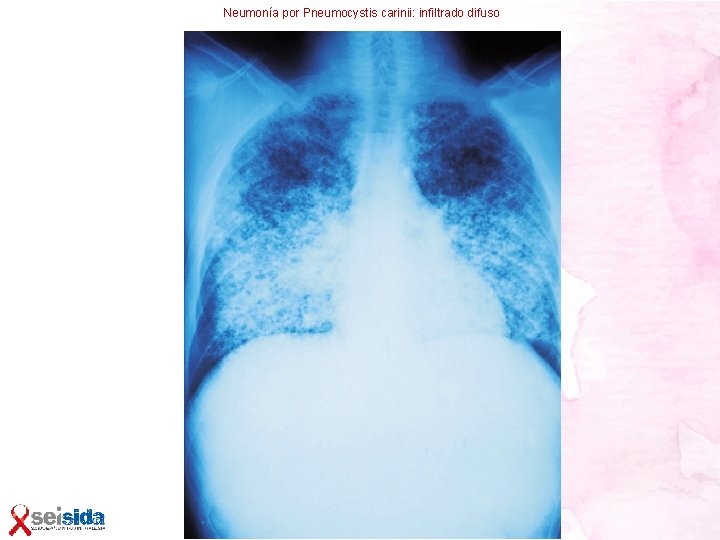 Neumonía por Pneumocystis carinii: infiltrado difuso 