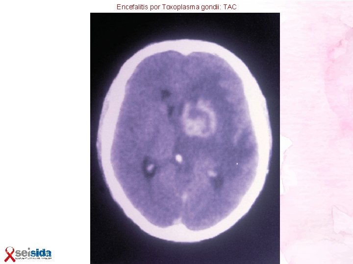 Encefalitis por Toxoplasma gondii: TAC 