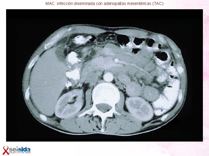 MAC: infección diseminada con adenopatías mesentéricas (TAC) 