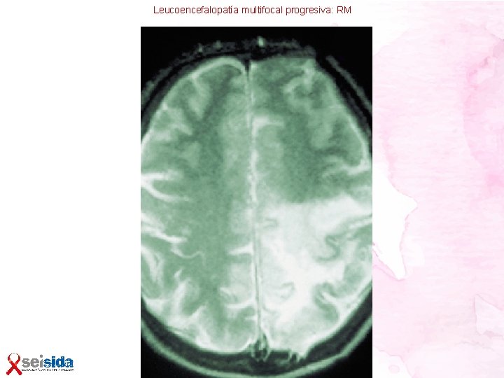 Leucoencefalopatía multifocal progresiva: RM 