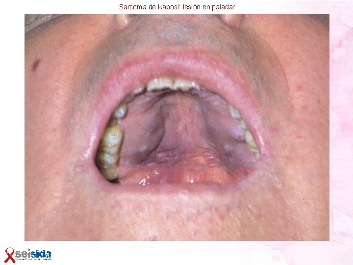 Sarcoma de Kaposi: lesión en paladar 