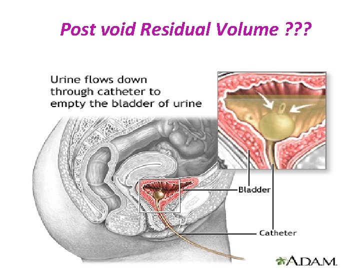  Post void Residual Volume ? ? ? 