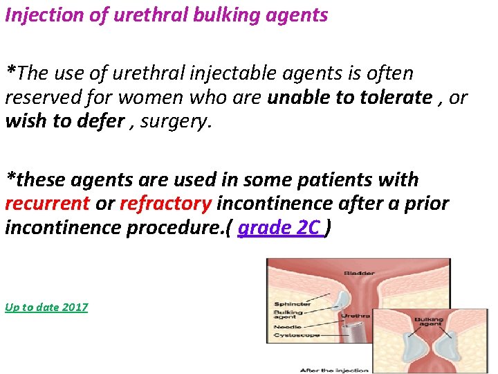 Injection of urethral bulking agents *The use of urethral injectable agents is often reserved