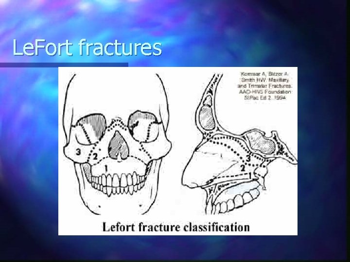 Le. Fort fractures 
