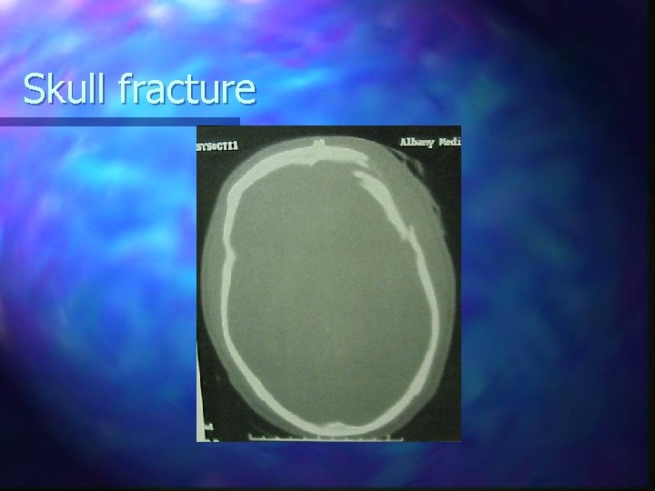 Skull fracture 