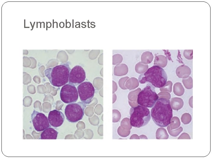 Lymphoblasts 