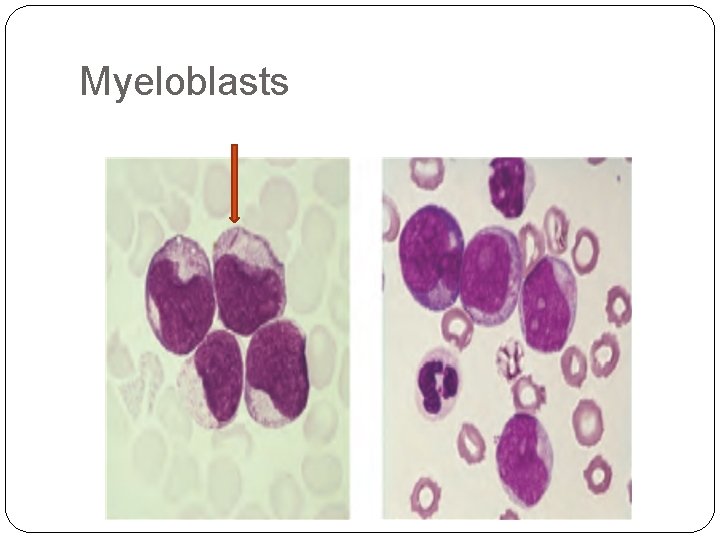 Myeloblasts 