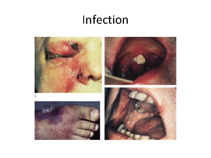 Infection 