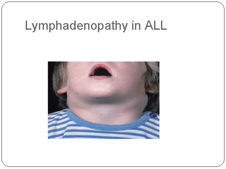 Lymphadenopathy in ALL 