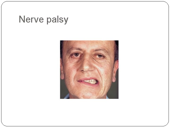 Nerve palsy 