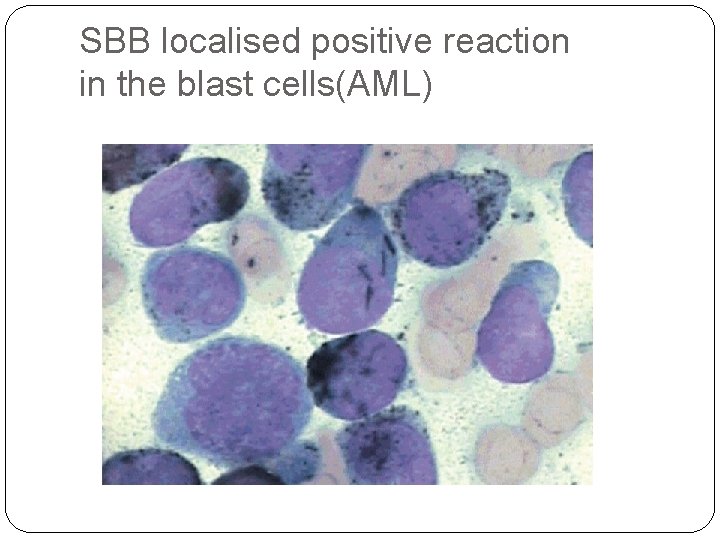 SBB localised positive reaction in the blast cells(AML) 