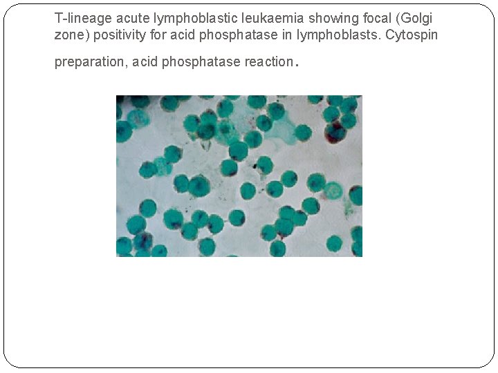 T-lineage acute lymphoblastic leukaemia showing focal (Golgi zone) positivity for acid phosphatase in lymphoblasts.