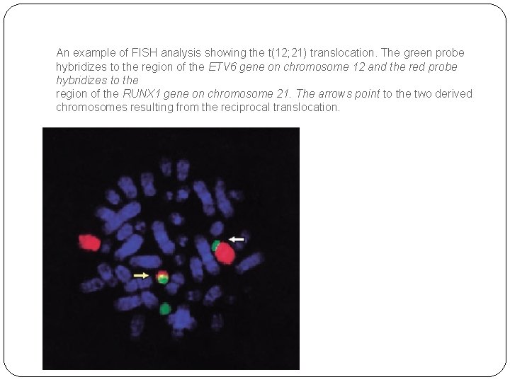 An example of FISH analysis showing the t(12; 21) translocation. The green probe hybridizes