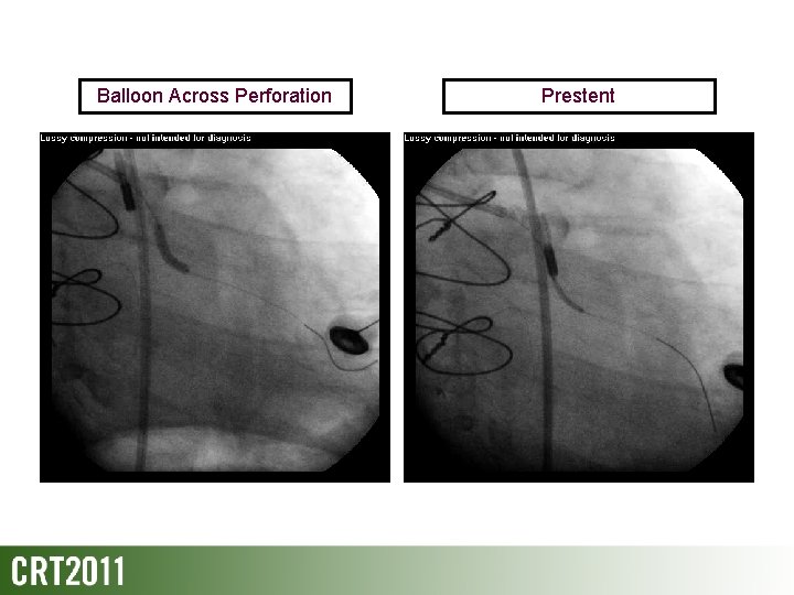 Balloon Across Perforation Prestent 