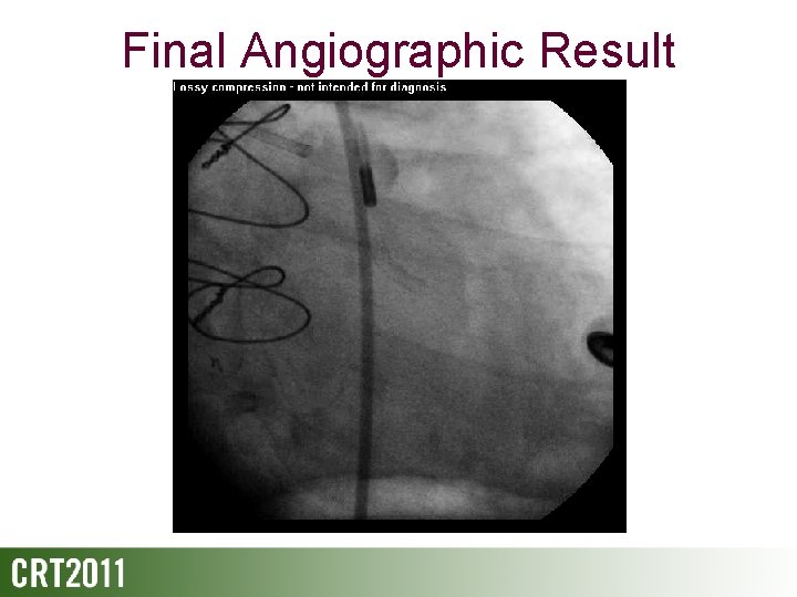 Final Angiographic Result 