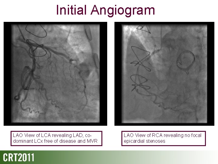 Initial Angiogram LAO View of LCA revealing LAD, codominant LCx free of disease and
