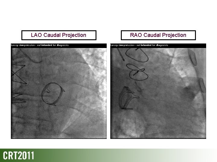 LAO Caudal Projection RAO Caudal Projection 