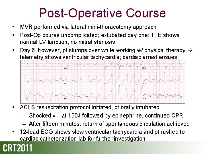 Post-Operative Course • MVR performed via lateral mini-thoracotomy approach • Post-Op course uncomplicated; extubated