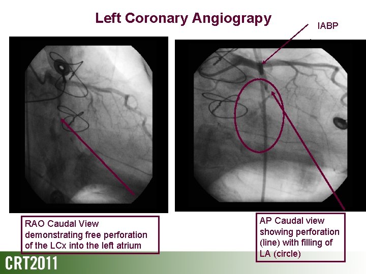 Left Coronary Angiograpy RAO Caudal View demonstrating free perforation of the LCx into the