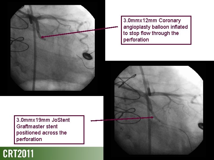 3. 0 mmx 12 mm Coronary angioplasty balloon inflated to stop flow through the