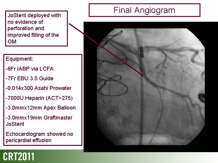 Jo. Stent deployed with no evidence of perforation and improved filling of the OM