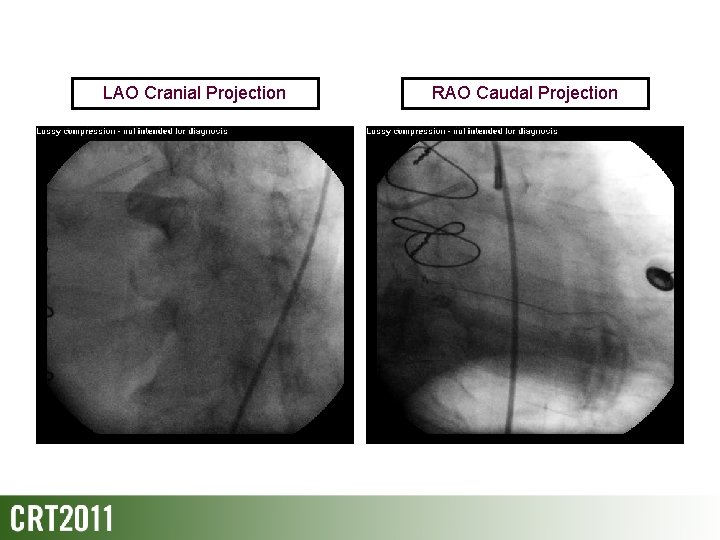 LAO Cranial Projection RAO Caudal Projection 