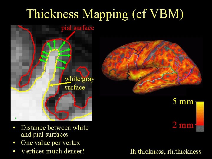 Thickness Mapping (cf VBM) pial surface white/gray surface 5 mm • Distance between white