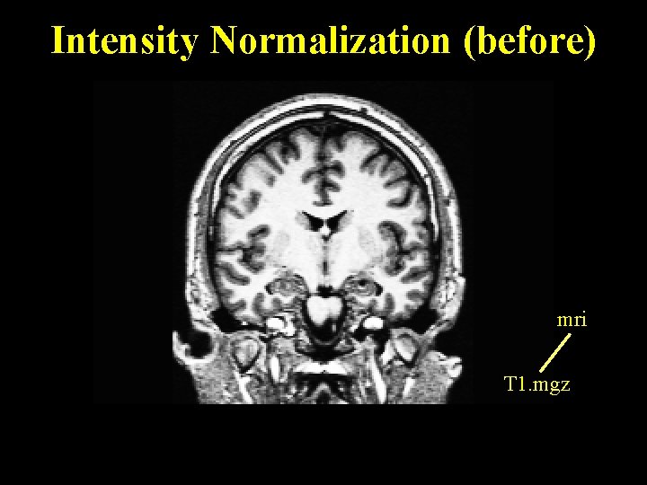 Intensity Normalization (before) mri T 1. mgz 