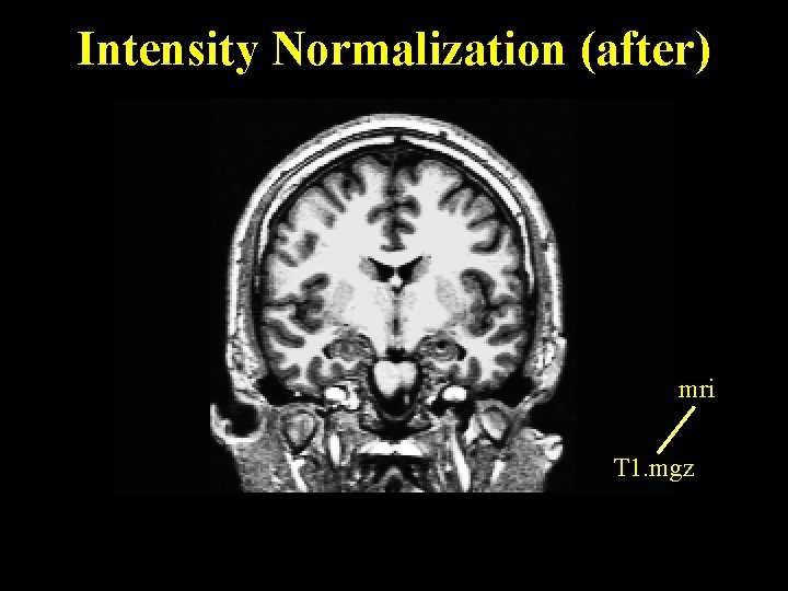 Intensity Normalization (after) mri T 1. mgz 