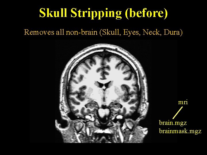 Skull Stripping (before) Removes all non-brain (Skull, Eyes, Neck, Dura) mri brain. mgz brainmask.