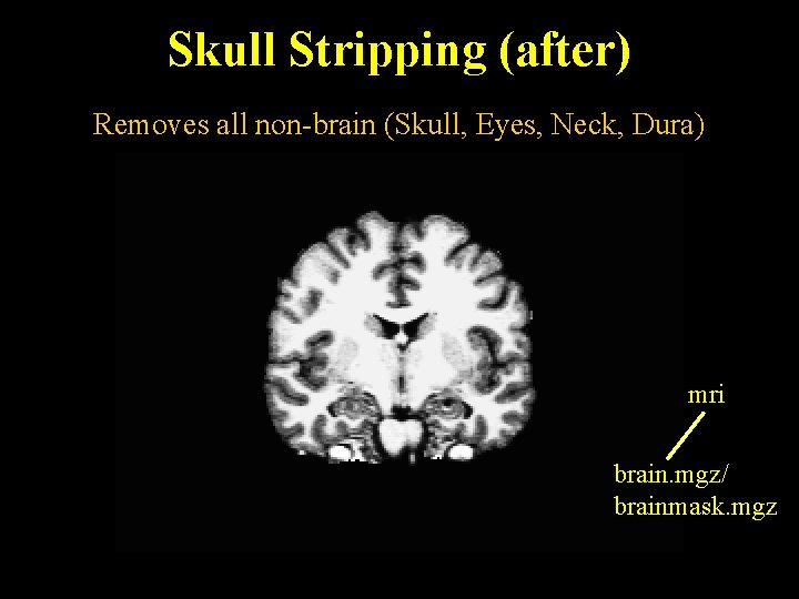 Skull Stripping (after) Removes all non-brain (Skull, Eyes, Neck, Dura) mri brain. mgz/ brainmask.