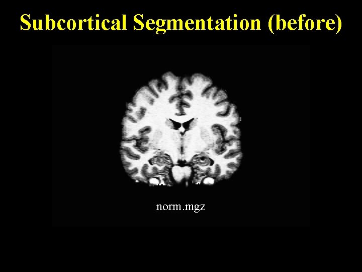 Subcortical Segmentation (before) norm. mgz 