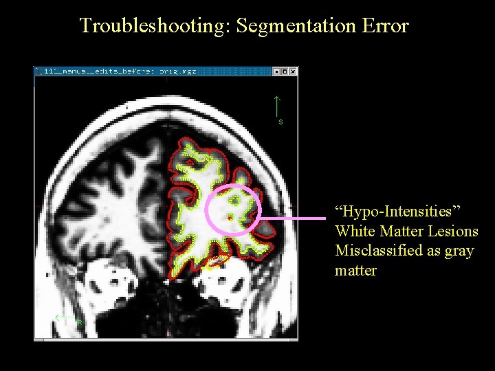 Troubleshooting: Segmentation Error “Hypo-Intensities” White Matter Lesions Misclassified as gray matter 