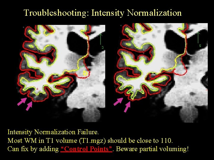 Troubleshooting: Intensity Normalization Failure. Most WM in T 1 volume (T 1. mgz) should