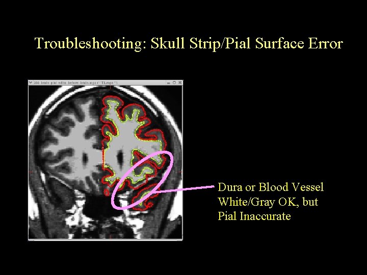 Troubleshooting: Skull Strip/Pial Surface Error Dura or Blood Vessel White/Gray OK, but Pial Inaccurate