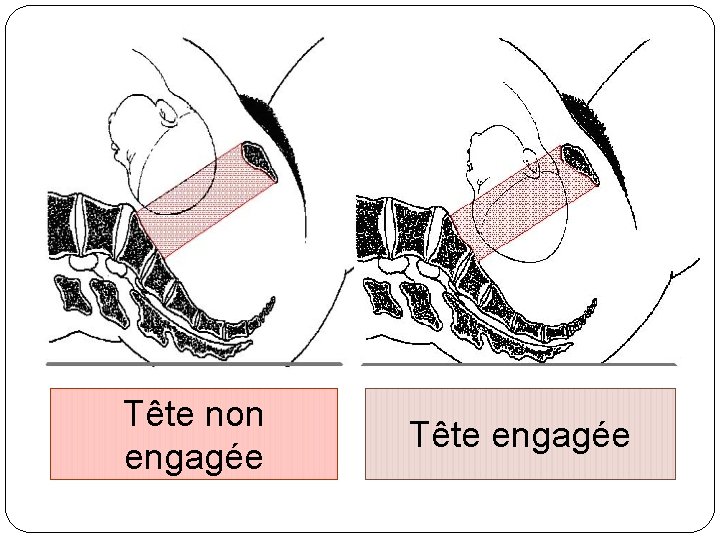 Tête non engagée Tête engagée 