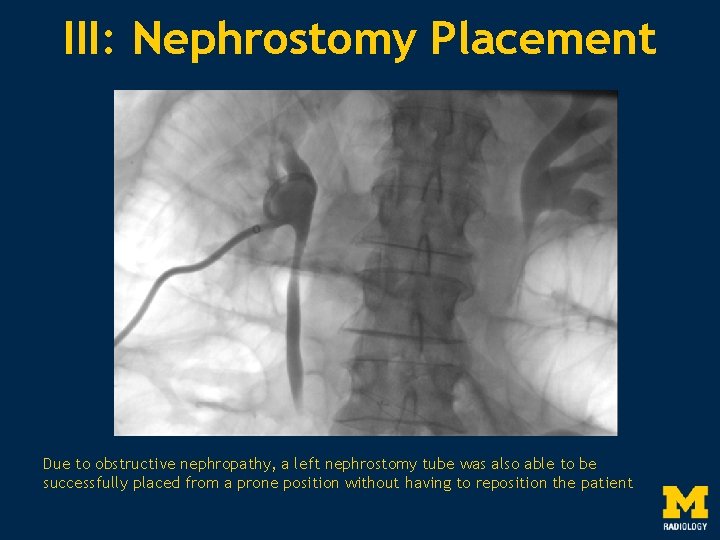 III: Nephrostomy Placement Due to obstructive nephropathy, a left nephrostomy tube was also able