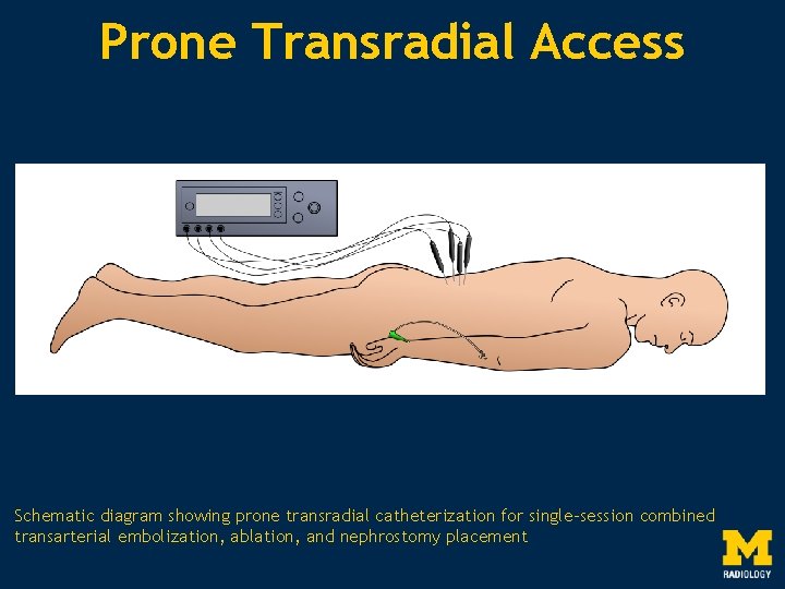 Prone Transradial Access Schematic diagram showing prone transradial catheterization for single-session combined transarterial embolization,