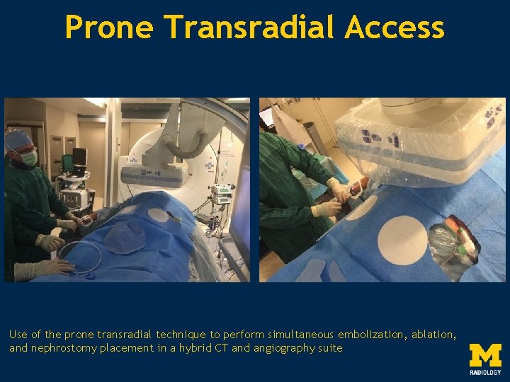 Prone Transradial Access Use of the prone transradial technique to perform simultaneous embolization, ablation,