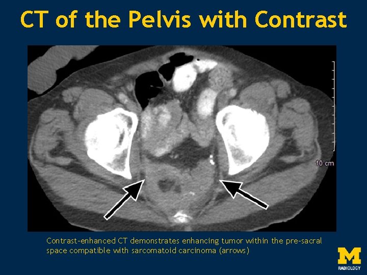 CT of the Pelvis with Contrast-enhanced CT demonstrates enhancing tumor within the pre-sacral space