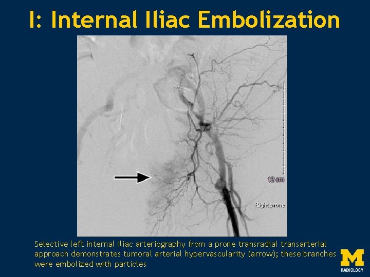 I: Internal Iliac Embolization Selective left internal iliac arteriography from a prone transradial transarterial
