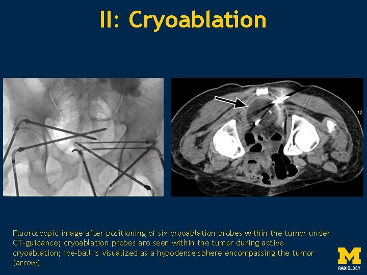 II: Cryoablation Fluoroscopic image after positioning of six cryoablation probes within the tumor under