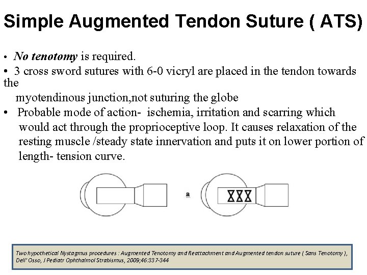 Simple Augmented Tendon Suture ( ATS) No tenotomy is required. • 3 cross sword